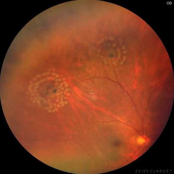 考研生用眼过度视网膜裂孔！高发于高度近视或中老年人